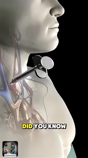 medico on Instagram: "CVC (Central Venous Catheter) insertion is a medical procedure to place a long, flexible tube into a large central vein (neck, chest, arm, or groin) leading to the heart, used for long-term IV access, medications, fluids, blood draws, or hemodynamic monitoring, often guided by ultrasound using the Seldinger technique for safety and precise placement in critical care settings. Key Aspects of CVC Insertion Purpose: Delivers meds/fluids (like vasopressors, TPN), draws blood, m