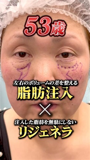 【クマ取り手術】ついに決断！クマ取りのオペに密着！#クマ取り #クマ取整形 #目の下のクマ #クマ診断 #クマ取りナビ #裏ハムラ #脂肪注入#美容整形#湘南美容クリニック