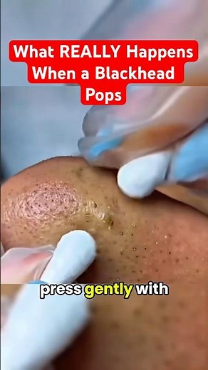 What REALLY Happens When a Blackhead Pops