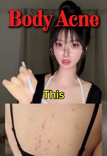 Body acne ✔️ checklist part 6 #koreanskincare #bodyacne #howtoglowup #acnetreatment #glowuptips