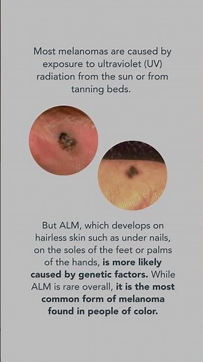 Melanoma Caused Bob Marley's Death