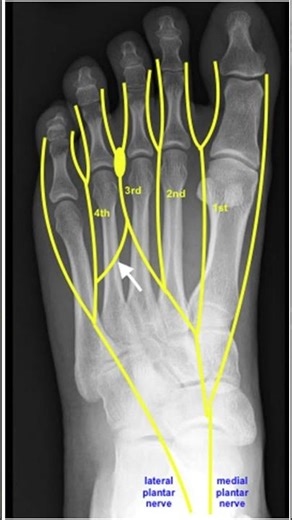 Deep Transverse Metatarsal Ligament Explained 🦶 #anatomy #meded #podiatry #physio #ATC