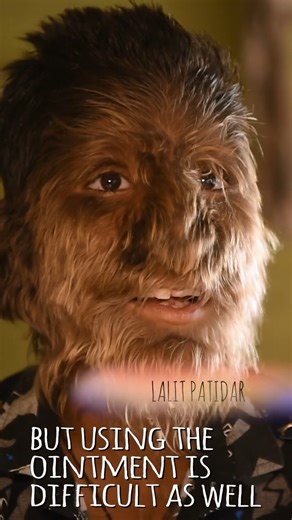 47K views · 371 reactions | The boy with 'werewolf syndrome' #reels #borndifferent #Hypertrichosis #werewolf #werewolfsyndrome #syndrome | Born Different | Facebook