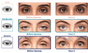 UPNEEQ Eye Opening Drops – Ptosis Eye Treatment