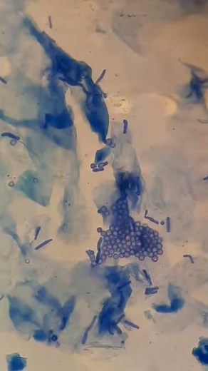 MALASSEZIA FURFUR (Pityrosporum ovale)