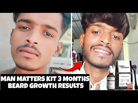 90 days beard growth results | man matters beard growth kit review | minoxidil beard | beard growth|