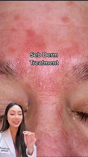 Seborrheic Dermatitis Treatment Tips