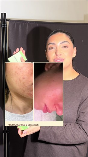 Un savon qui combat imperfections, acné et sébum en moins de deux semaines… 🤭🫣 Ta peau va adorer .. #tiktokshop#imperfections #sebum