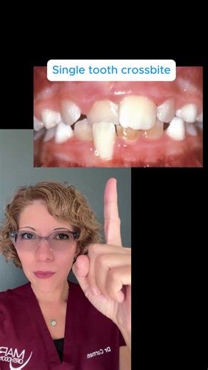 If one tooth is biting the wrong way, don’t ignore it. A single-tooth crossbite can cause traumatic occlusion, leading to gum recession and bone loss. This doesn’t fix itself. Early treatment by a specialist orthodontist can help. Ages 6–7 are the right time to check.