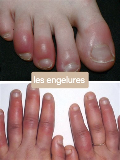 les engelures sont très douloureuses mais pas toujours dûes au froid.#engelures#peau#doigts_rouges#dermqtologie#creatorsearchinsights