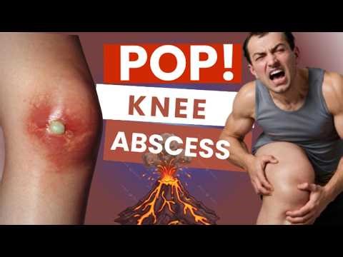 POV: Lancing a Massive Knee Abscess – Pus, Pressure & Relief | Ortho POV