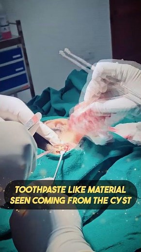 Safe & Precise Cyst Removal Near Eye by Dr. Rohit Jain | Watch Before & After!