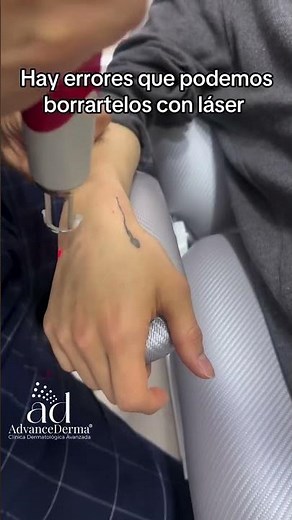 Remove the tattoo you no longer want