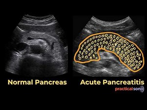 Normal vs Pancreatitis Ultrasound (Detailed Explanation)