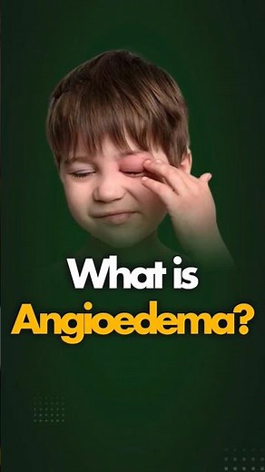 What are the Causes and Symptoms of Angioedema? #Shorts