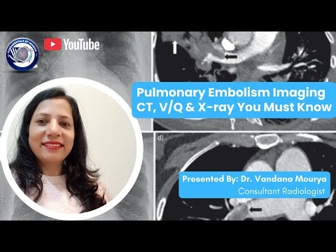 Pulmonary Embolism Imaging Algorithm: CTPA, VQ & X ray You Must Know