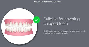 13K views · 39 reactions | Did you know? .... INSTAsmile is an ideal solution for covering crooked teeth, overcrowding, natural gaps between teeth, missing teeth, chipped teeth, discoloured teeth and covering open bites. We've got you covered! www.instasmile.com/gb to find out more :-) | instasmile | Facebook