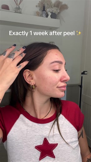 Amazing Results from Chemical Peel | Before and After | Glowing Skin
