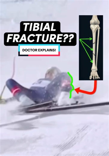 Lindsey Vonn's Complex Tibial Fracture Explained