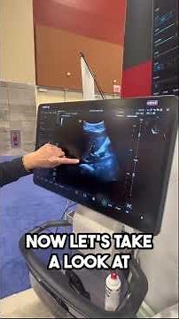 Ultrasound to measure IVC Collapsibility | IVC collapse demo