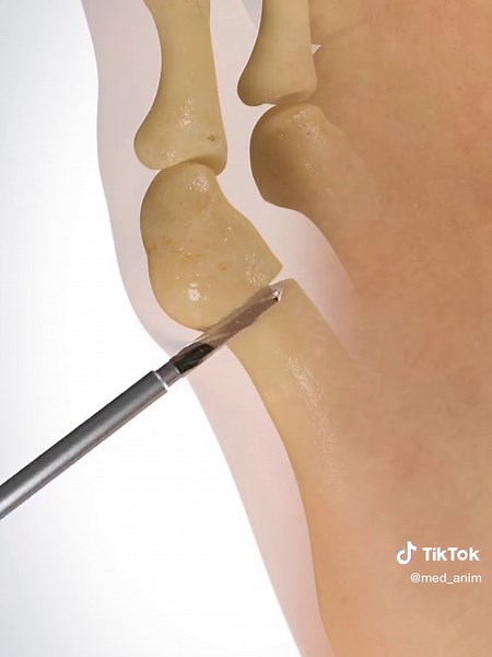 Bunionette, or tailor’s bunion #meditok #fyp #3danimation | 3d animation
