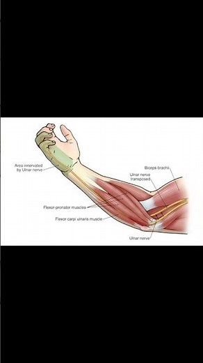 Finger Flexion Sign | Ulnar Nerve Test Explained #meded #ortho #ATC #physio #neurology