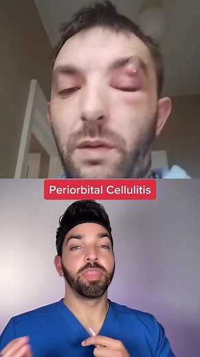 #duet with @hazzardousapples 0/10 #dermdoctor #pimplepopping #abscess #periorbitalcellulitis