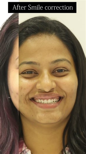 Deepa sathish smile transformation at Opal dentistry with Invisalign by Dr.Kirubaharan #deepasathish