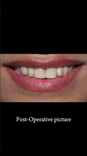 Composite Build-up of Tooth 21: Coltene & Shofu Technique #shorts #dentist