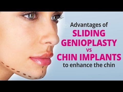 Advantages of Sliding Genioplasty vs Chin Implants for Augmenting the Chin
