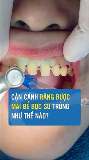 Quy Trình Mài Răng Chuẩn Bị Bọc Sứ #nhakhoanganphuong