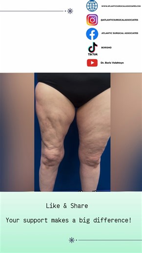18 reactions | This case demonstrates why lipedema surgery requires a disease-specific approach. Standard cosmetic liposuction techniques can lead to contour irregularities, scarring, and the need for revision. Call: (732) 641-3350 Visit: www.atlanticsurgicalassociates.com www.lipedemamd.com #lipedema #waterjetassistedliposuction #lipedemafighter #lipedemaawareness #lipedemasurgery lipedematreatment | Atlantic Surgical Associates | Facebook