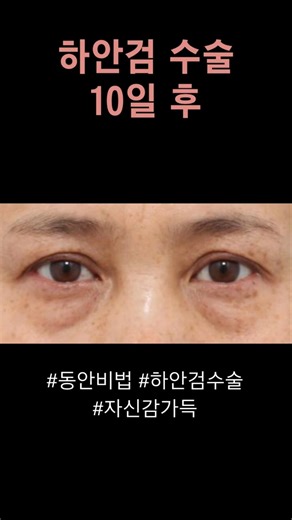 하안검 수술 후 10일~ 이렇게 회복이 빠르다고~10일 후 10년 젊어진 내 모습^^