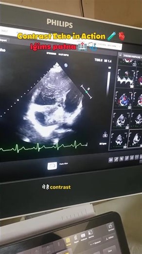 Contrast echo in action||igims patna 🏥🫀🥼 #cardiology