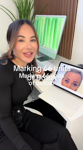 Marking 66 Units of Botox: A Step-by-Step Guide