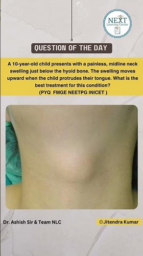 Option are :- A. Simple cyst excision B. Antibiotic therapy C. Sistrunk operation D. Aspiration