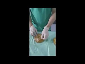Capsular Contracture Breast Implants - Causes and Treatment ( Dr Khoo Lee Seng)