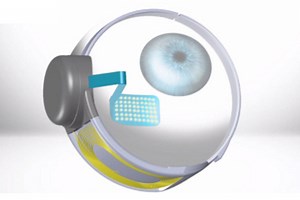 Second Sight's Bionic Eye Implanted In First U.S. Patients