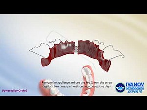 Schwartz Expander Appliance