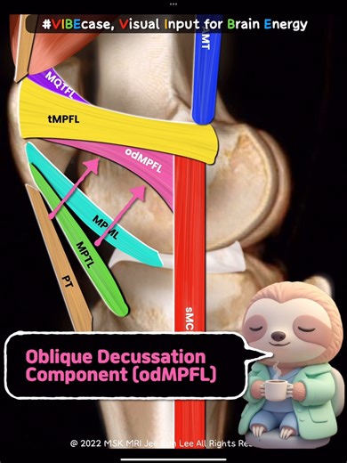 MSKMRI on Instagram: "📌 When the MPFL Tears Without Patellar Dislocation Direct-impact MPFL tears: subtle, rare, and easy to miss. Isolated MPFL Tear from Direct Medial Contusion — Extremely Rare The MPFL almost always tears due to transient lateral patellar dislocation, accompanied by the classic bone bruise pattern (medial patella + lateral femoral condyle). But in this case? The patient had no dislocation, only a direct medial impact. Key MRI clues suggesting a true contusion-only MPFL tear: