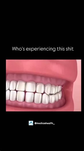 Medical & Health ⚕️ on Instagram: "Ever wonder why wisdom teeth cause so much trouble? 🦷 When there isn’t enough room in the jaw, these late-bloomers can become “impacted,” growing at an angle and pushing against your other teeth. This doesn’t just cause pain-it can lead to crowding, cysts, and even damage to healthy molars. If you’re feeling that pressure in the back of your jaw, it might be time for an X-ray! . . Dm for credit or removal 👏🏻 . . #viral #explore #biology #science #knowledge"