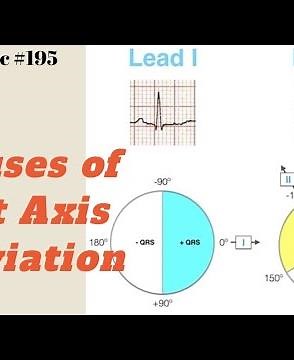 What are the Causes of Left Axis Deviation ECG | A simple Mnemonic to memorize all causes