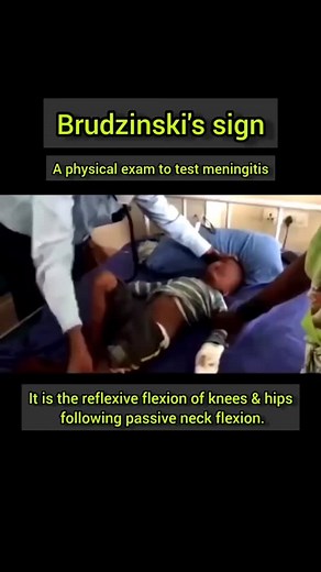 360°medico on Instagram: "Brudzinski's sign, a physical exam to test meningitis. It is the reflexive flexion of knees & hips following passive neck flexion. Must be supplemented with Kernig sign testing. Lumbar puncture (LP) can be done if no contraindications are present, like increased intracranial pressure (ICP), which may result in dangerous brain herniation. #medstudent #medicine #doctors #medicinefiles #med #doctorlife #doctors Shrink"