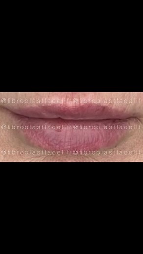 Plasma Pen Lip Lift: Natural Before & After Results