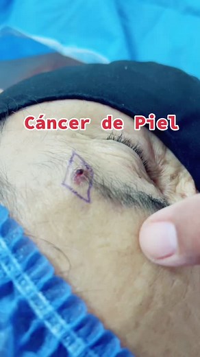 #cancerdepiel #sol #drwilfridosolano #dermatoscopy #skin #salud #piel #dañosolar