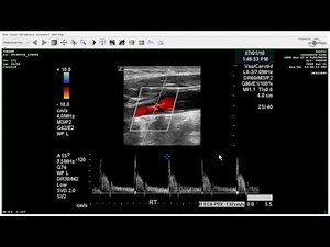 Carotid Duplex: Total Occlusion - Case Study