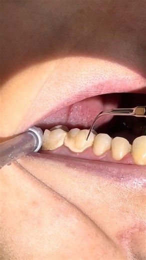 Professional Dental Cleaning | Upper Molar Calculus Removal 🦷