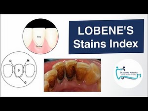 DENTAL STAINS INDEX/LOBENE'S INDEX/MACPHERSON 'S MODIFIED INDEX/ DR. ANKITA KOTECHA