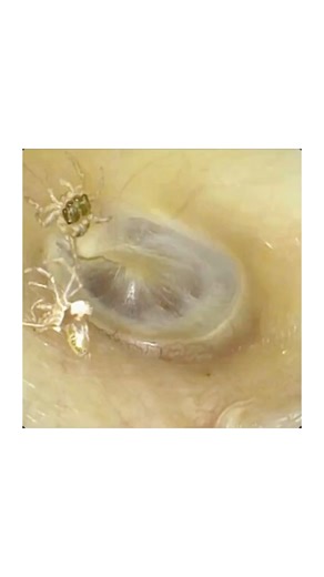 State of Medicine on Instagram: "A patient with hypertension arrived at the ENT clinic after 4 days of hearing abnormal sounds in her left ear. What she described as beating, clicking, and rustling had even caused insomnia. During examination, the unexpected culprit was found: 🕷️ a small spider actively moving inside the external auditory canal - along with its molted exoskeleton. The tympanic membrane remained intact. Using a suction cannula through an otoscope, both the spider and the exoskel