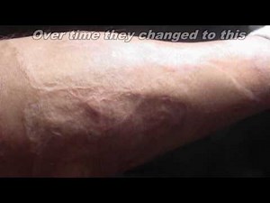 BURN SCARS - a photo montage showing my 3rd degree burn scars